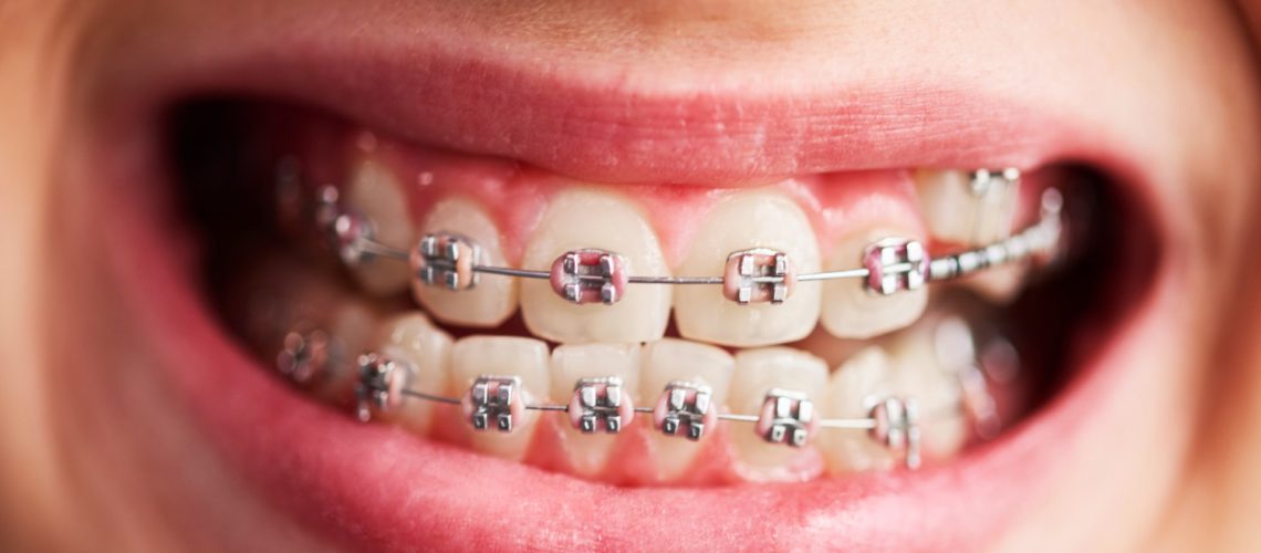 Ceramic Braces Cost in Dubai