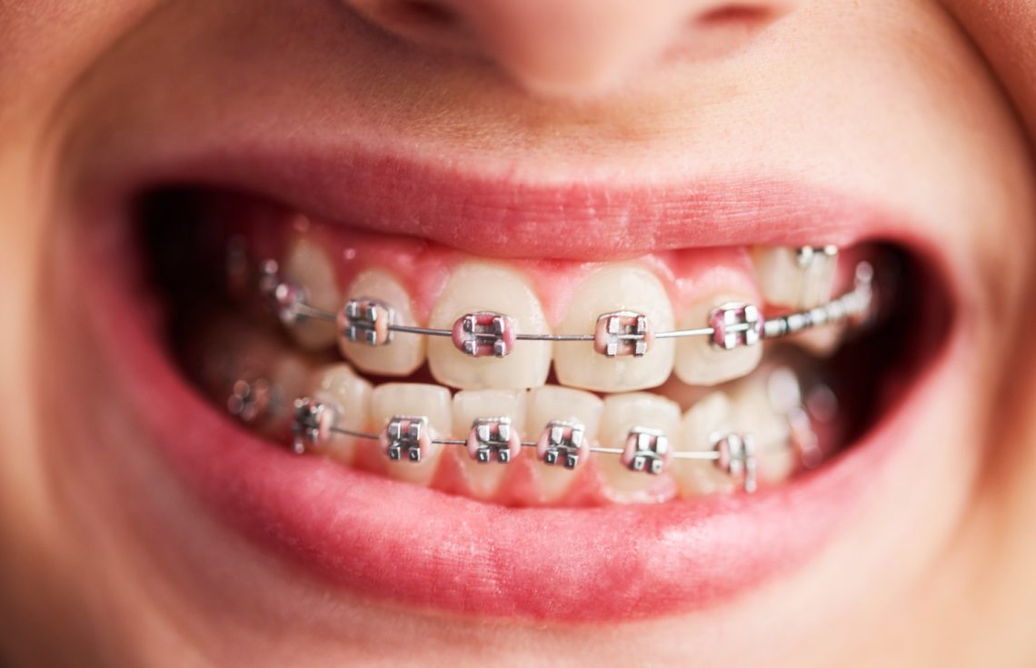 Ceramic Braces Cost in Dubai