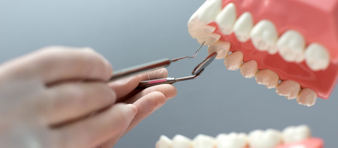 Dental Bridges vs. Implants in Dubai