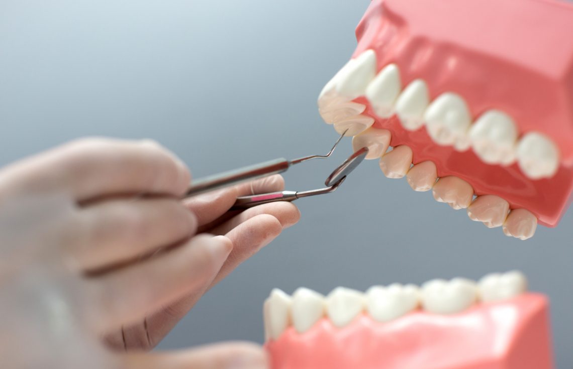 Dental Bridges vs. Implants in Dubai