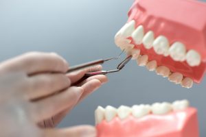 Dental Bridges vs. Implants in Dubai