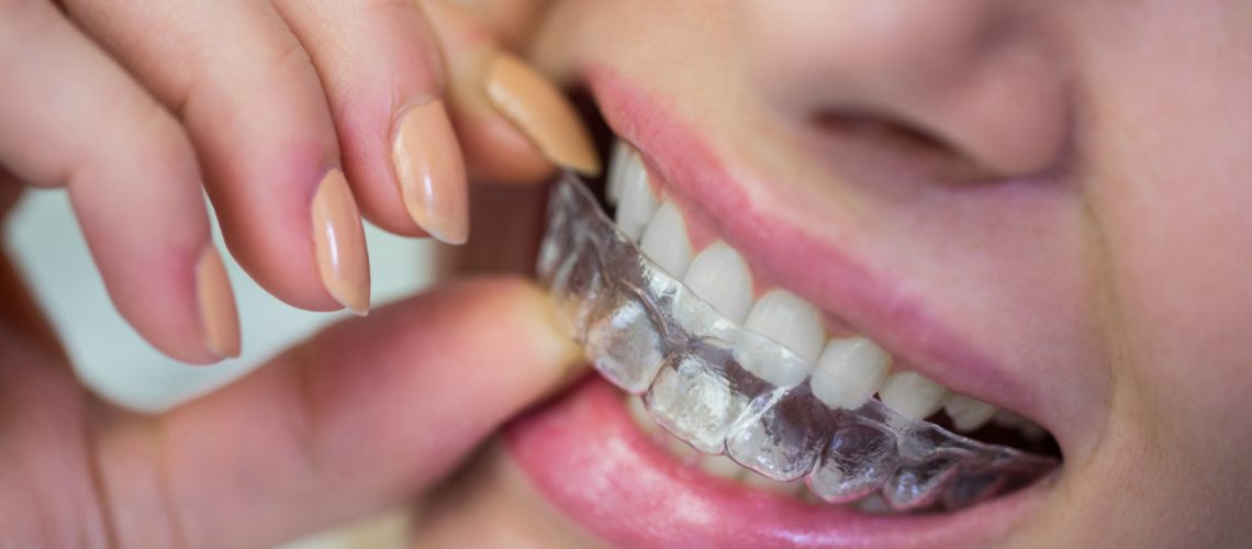 Invisalign Cost in Dubai