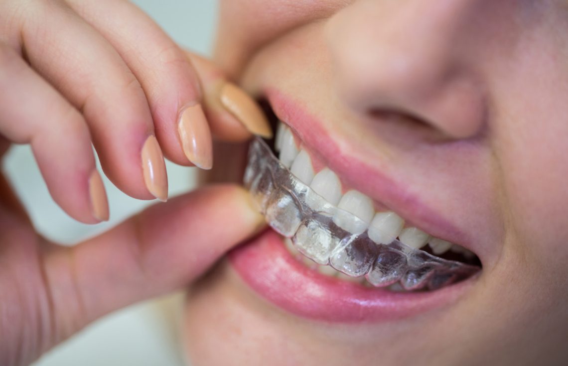 Invisalign Cost in Dubai