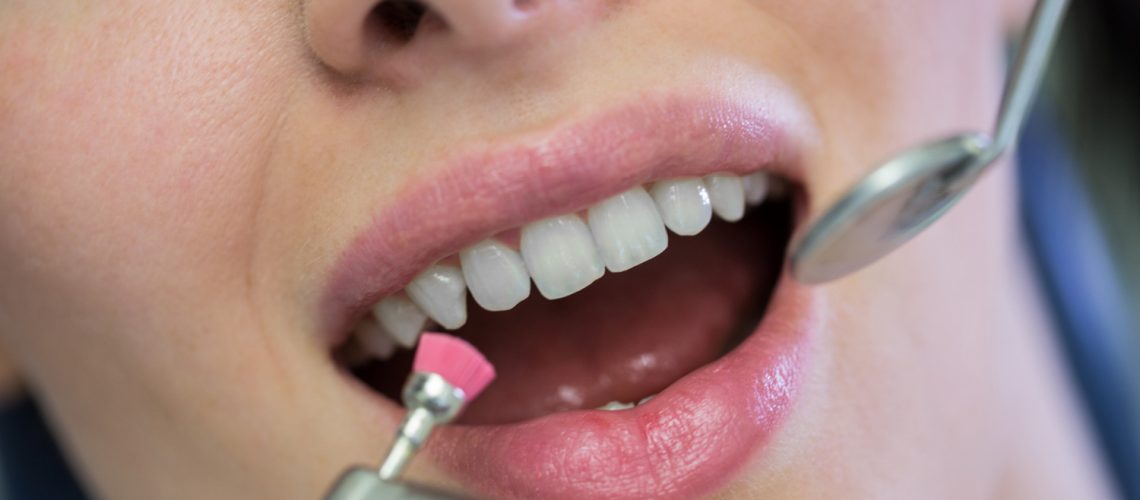What To Avoid After Teeth Whitening in Dubai