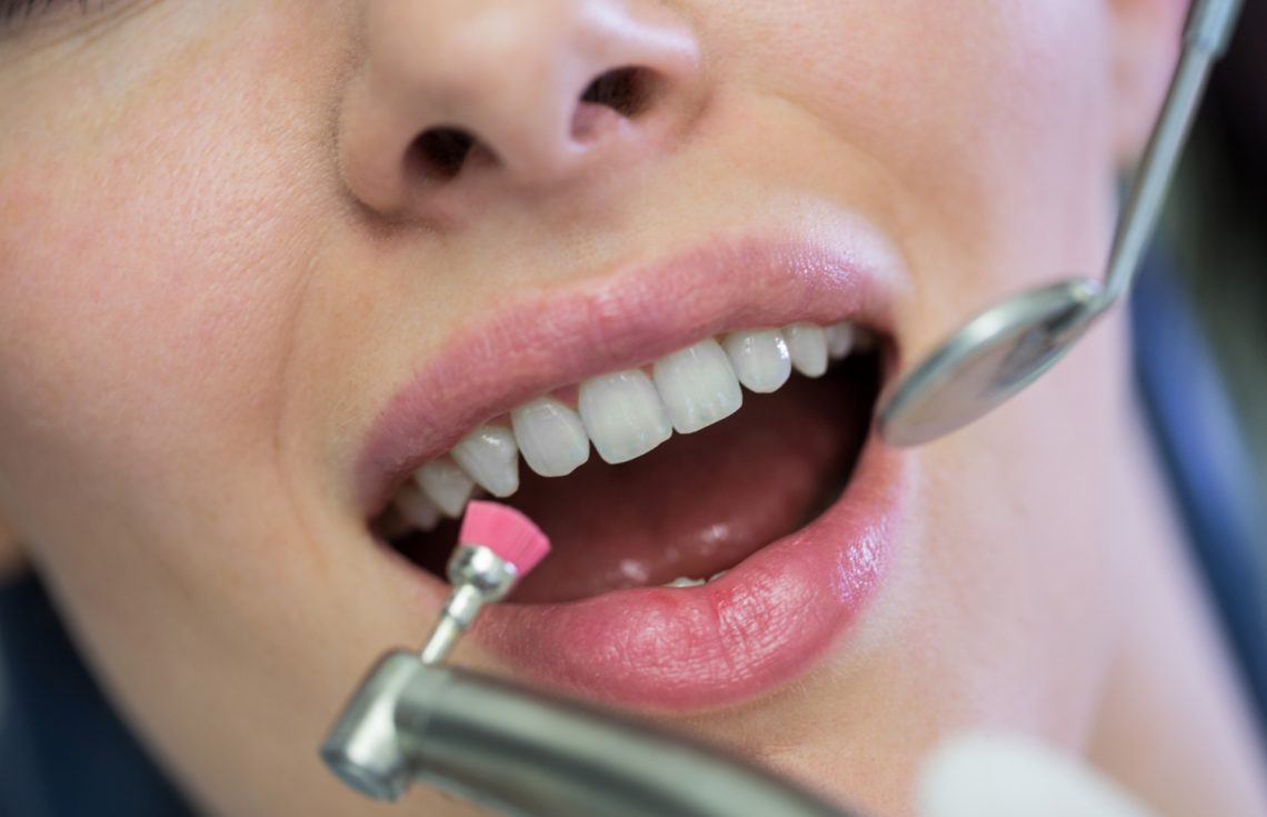 What To Avoid After Teeth Whitening in Dubai