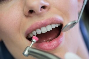 What To Avoid After Teeth Whitening in Dubai
