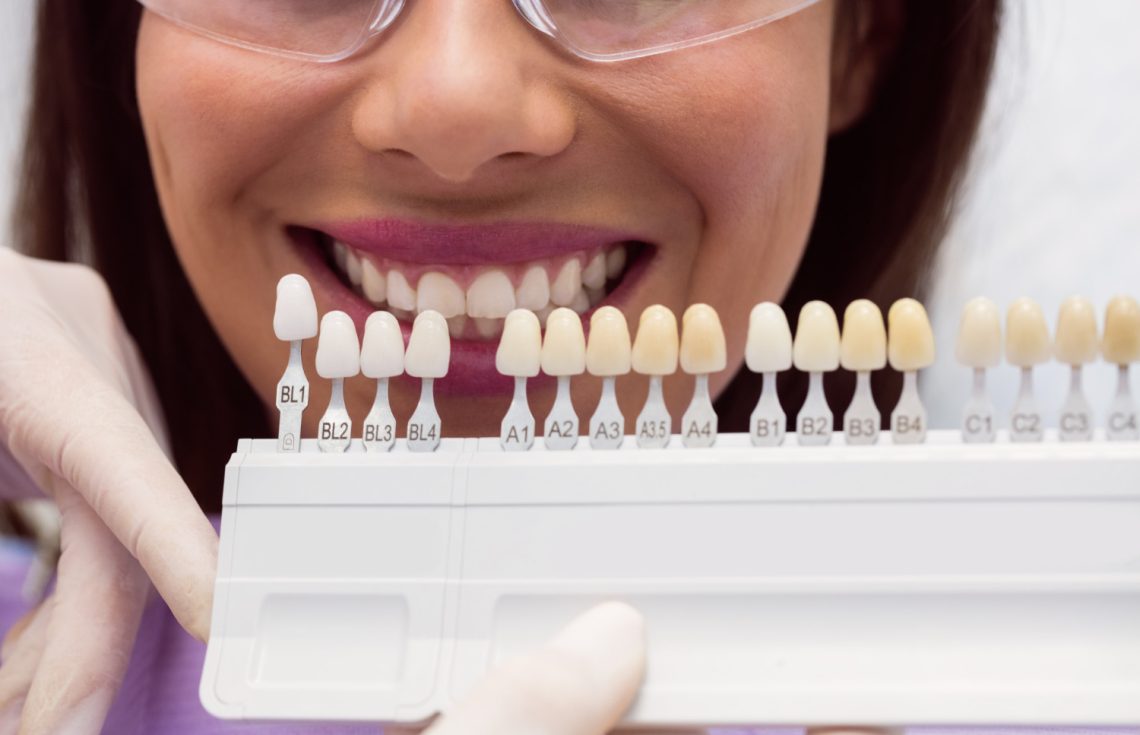 Dental Veneers What You Need To Know