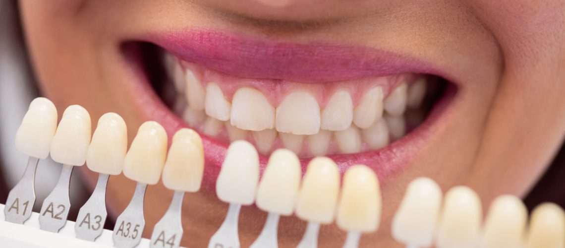 Everything You Need To Know About Dental Veneers