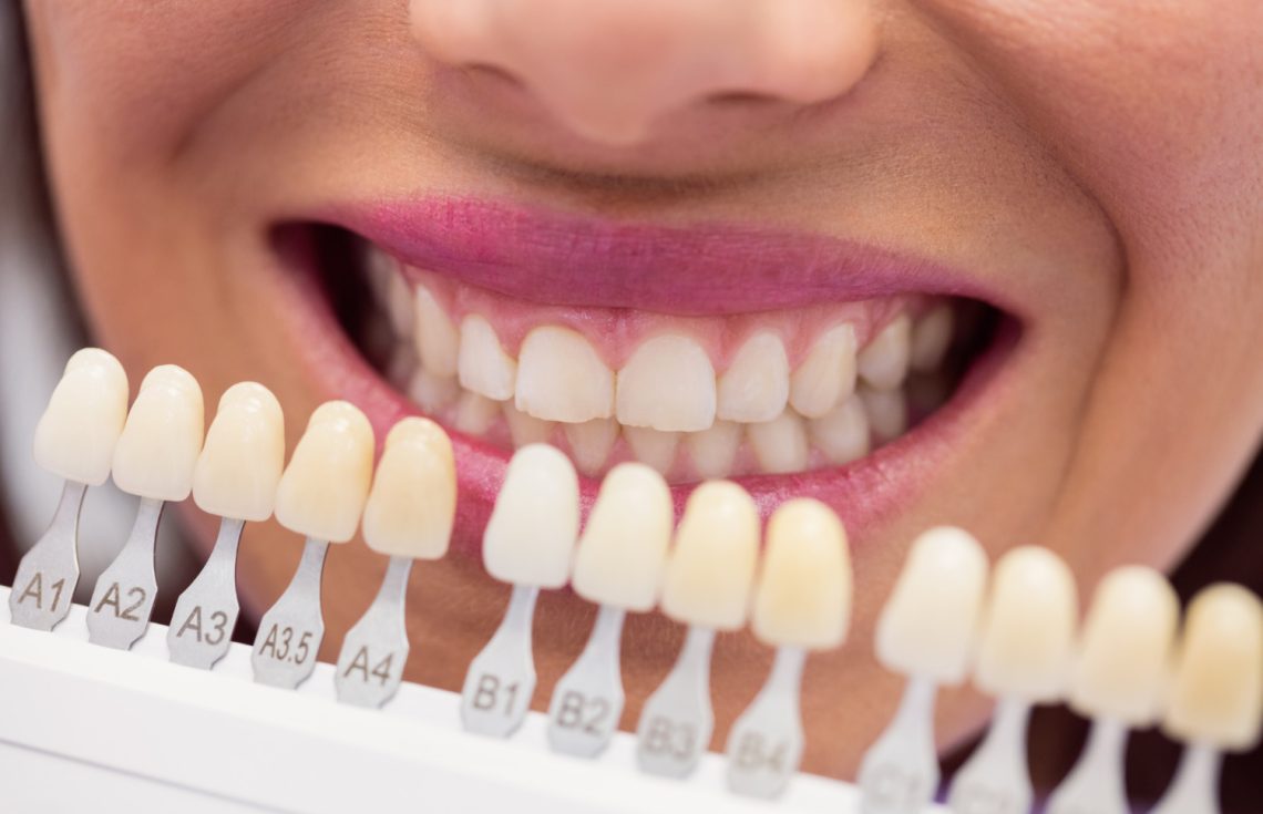 Everything You Need To Know About Dental Veneers