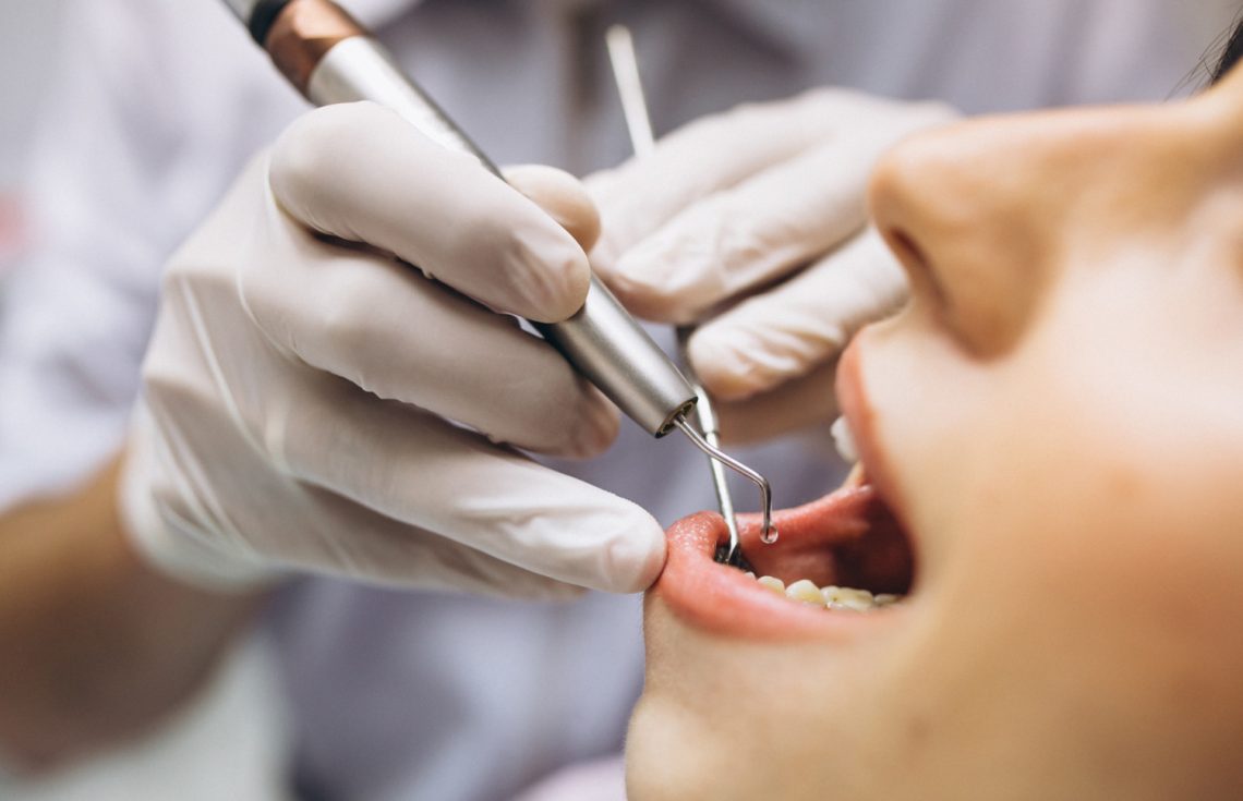 Teeth Stains Causes, Types, And How To Remove Teeth Stains