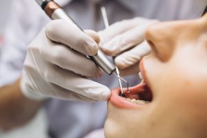 Teeth Stains Causes, Types, And How To Remove Teeth Stains