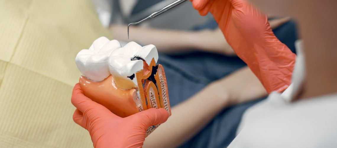 Root Canal Treatment In Dubai By An Italian Dentist Pain Relief And Tooth Preservation