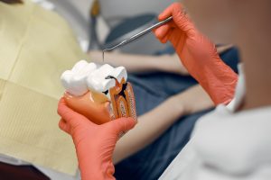 Root Canal Treatment In Dubai By An Italian Dentist Pain Relief And Tooth Preservation