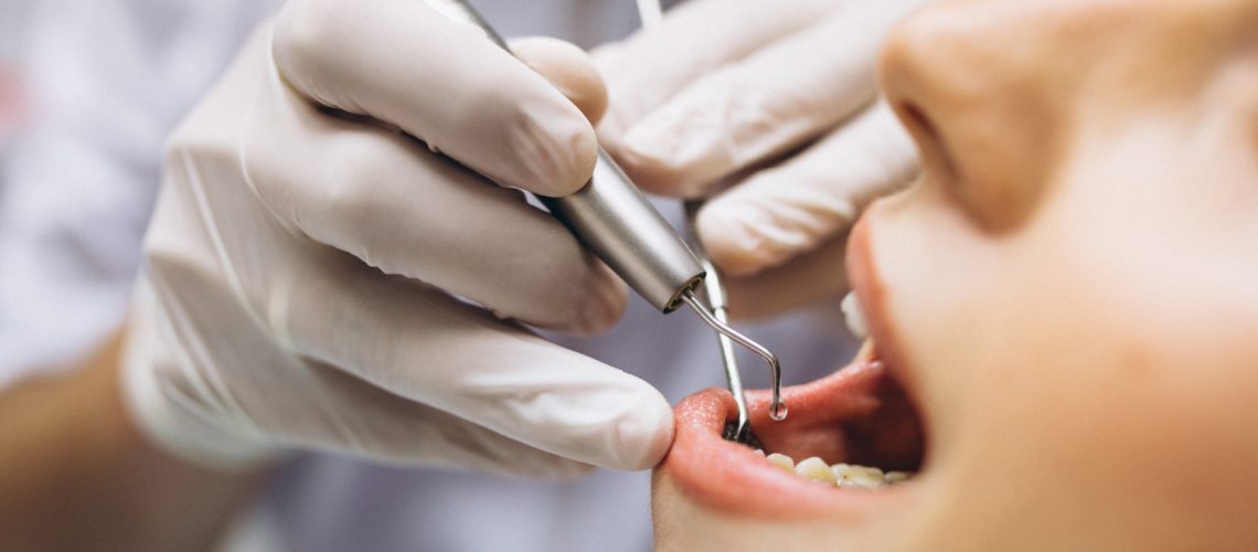 The Longevity Of Dental Fillings How Long Do They Last