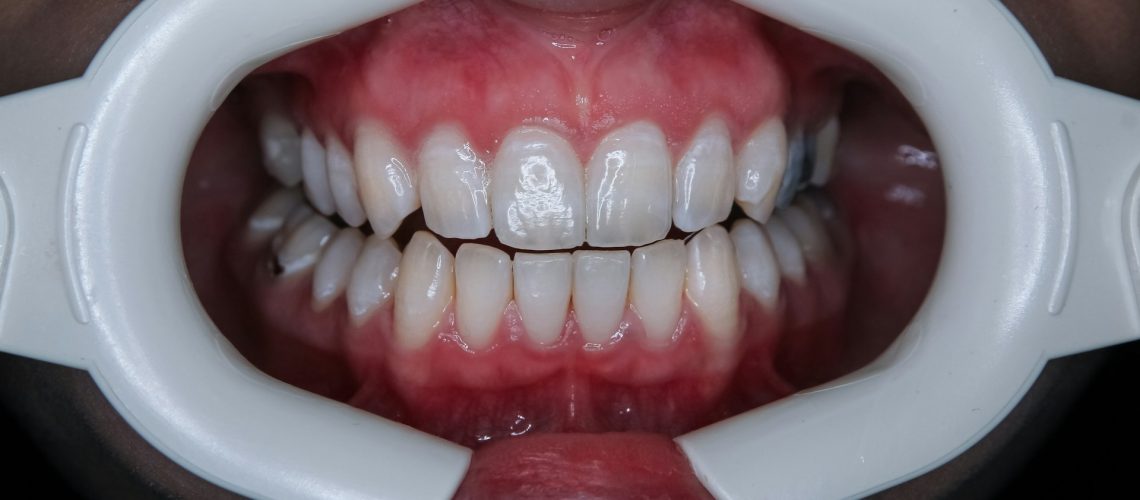 Why Do My Gums Bleed When I Floss
