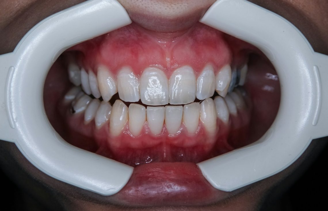 Why Do My Gums Bleed When I Floss