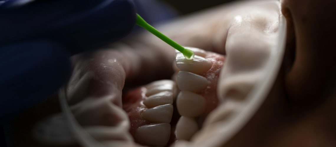Designing Your Custom Smile with Dental Veneers
