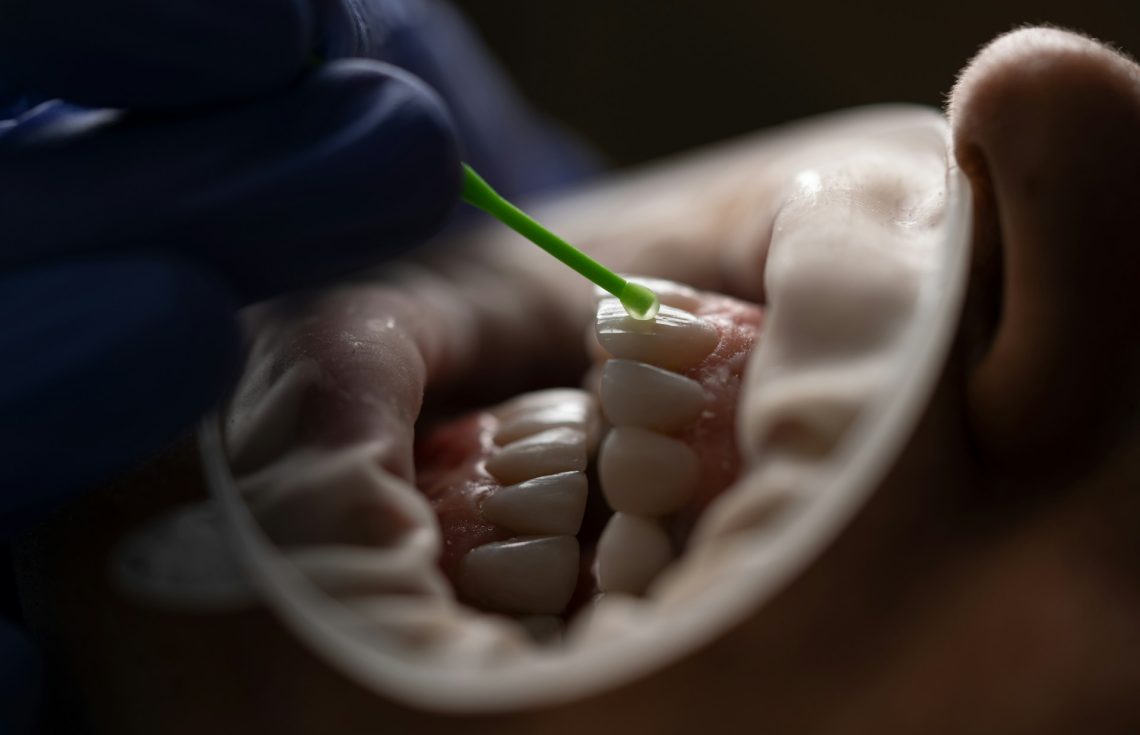 Designing Your Custom Smile with Dental Veneers