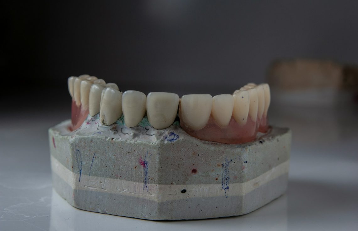 Enhance Your Smile With E.max Veneers The Ultimate Guide