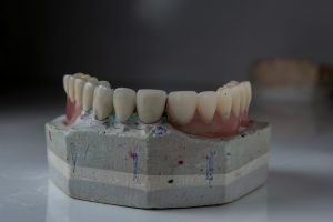 Enhance Your Smile With E.max Veneers The Ultimate Guide