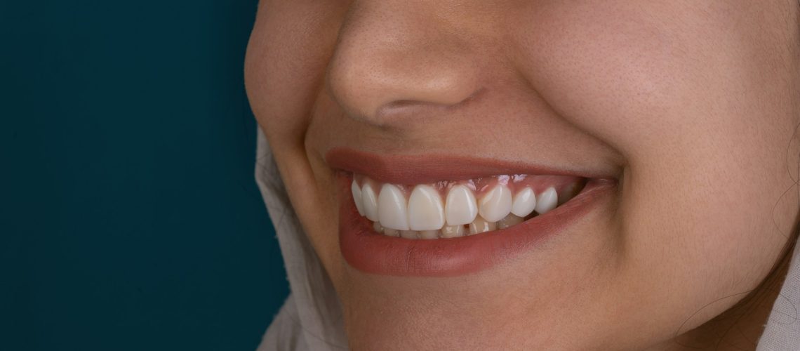 Exploring The Hollywood Smile Procedure In Detailed Steps