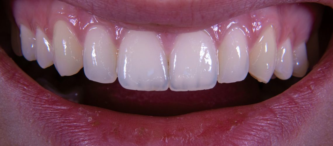 How To Fix A Gummy Smile – Treatments That Balance Your Smile