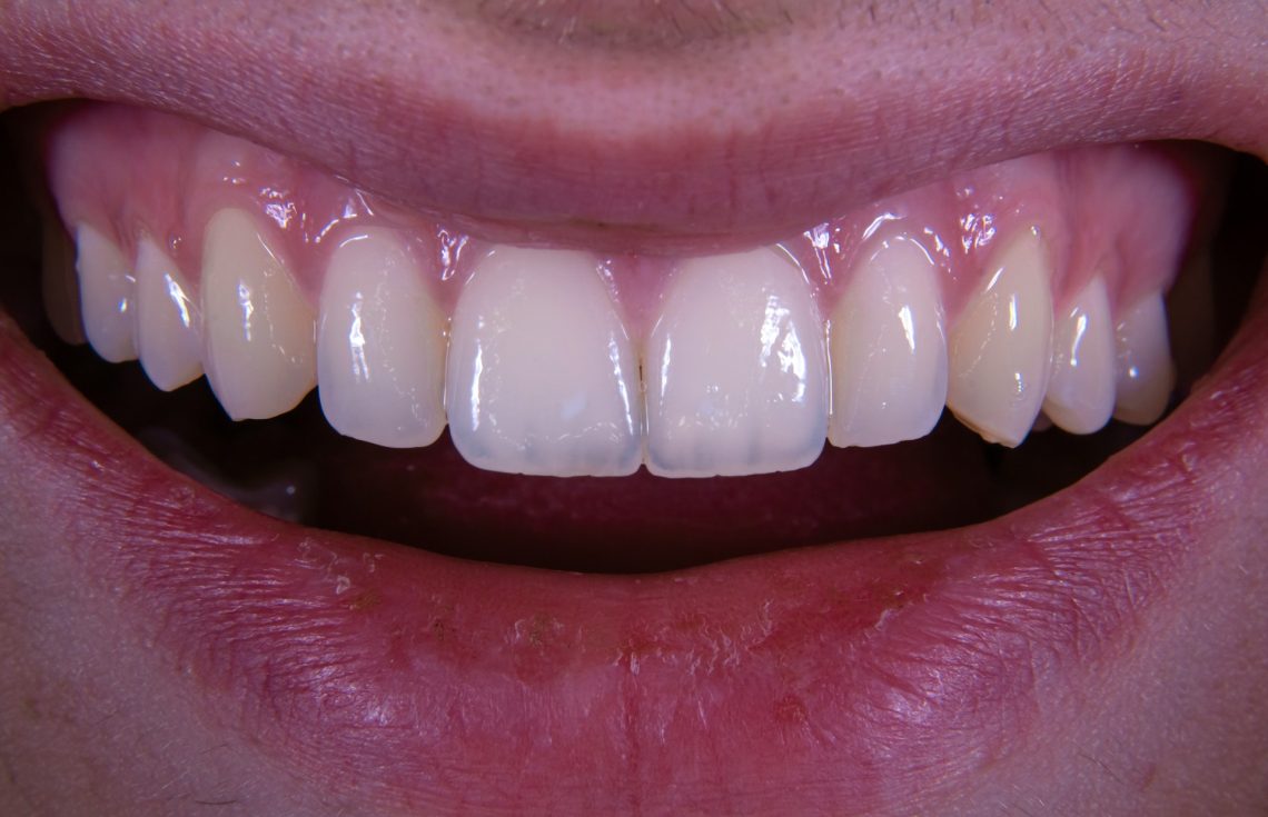 How To Fix A Gummy Smile – Treatments That Balance Your Smile