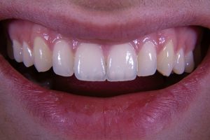 How To Fix A Gummy Smile – Treatments That Balance Your Smile