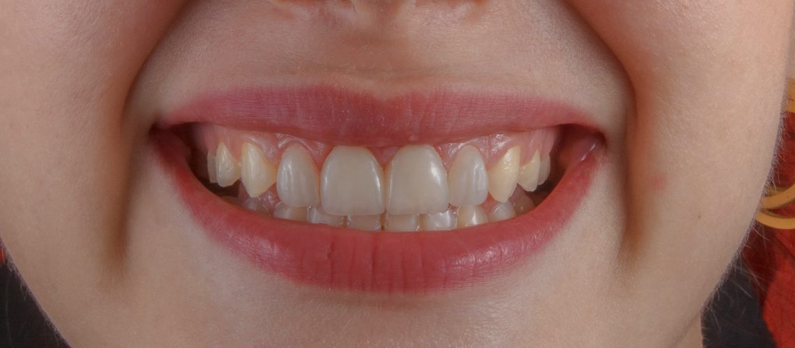 How To Get A Hollywood Smile In Dubai 7 Smile Design Techniques