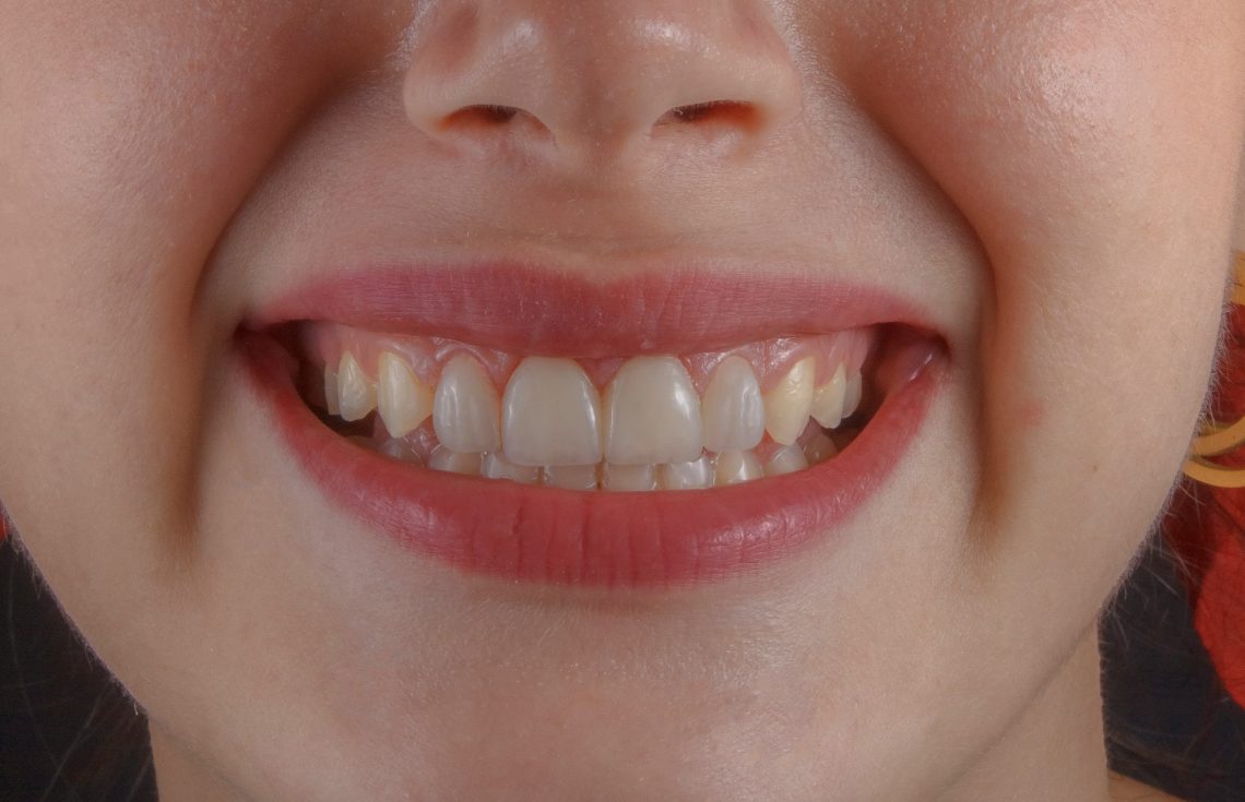 How To Get A Hollywood Smile In Dubai 7 Smile Design Techniques
