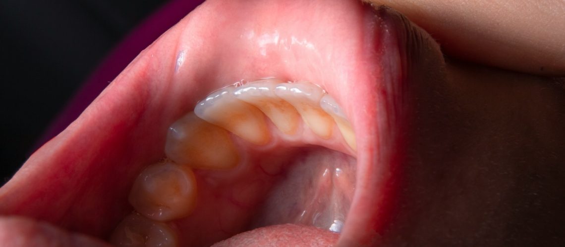How To Remove Stains from Teeth