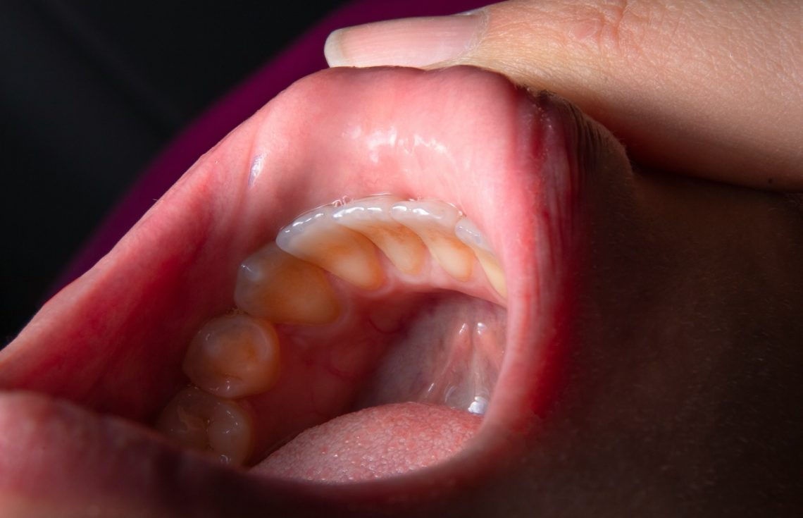 How To Remove Stains from Teeth