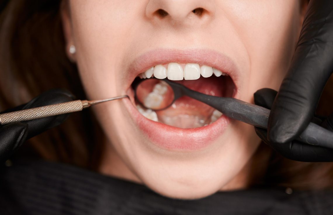 Teeth Stain Removers Guide