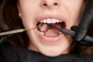Teeth Stain Removers Guide