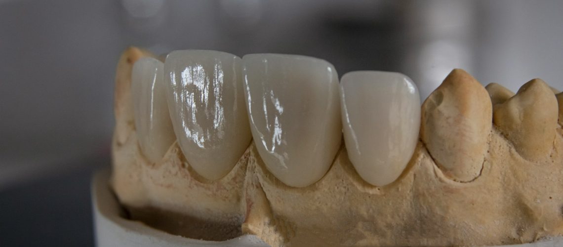 Things You Should Know About Zirconia Dental Crowns