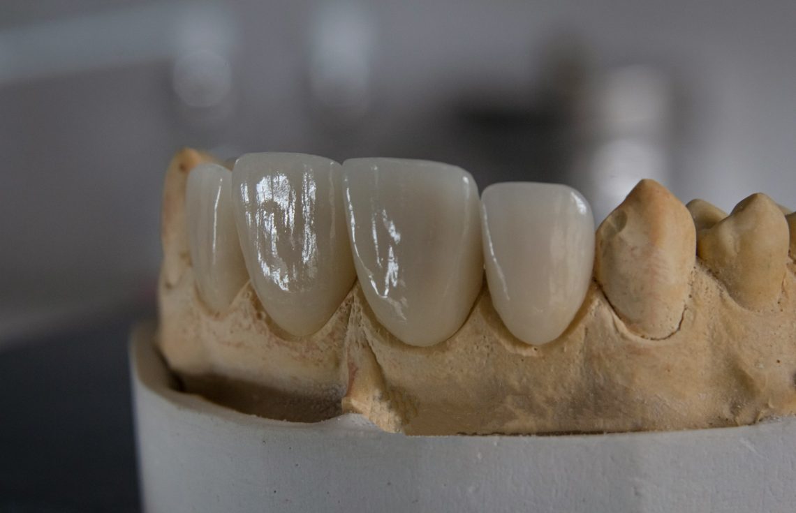 Things You Should Know About Zirconia Dental Crowns