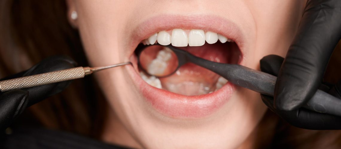 A Comprehensive Guide To Dental Fillings In Dubai Restoring Your Oral Health
