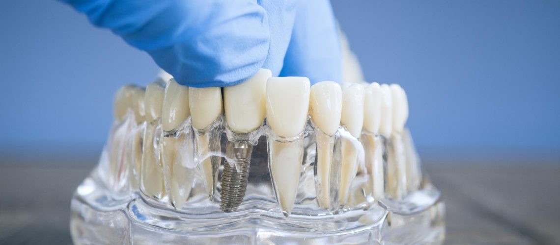 The Ultimate Dentist's Guide To Crown & Bridge