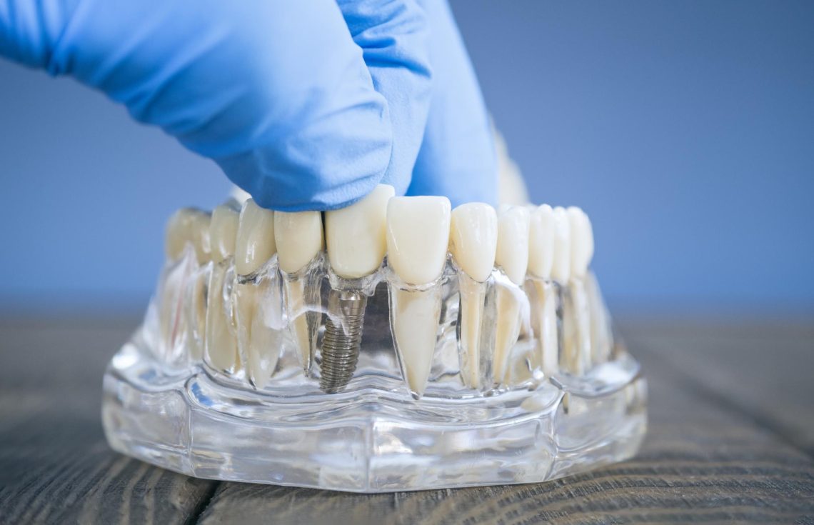 The Ultimate Dentist's Guide To Crown & Bridge