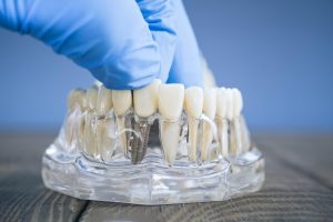 The Ultimate Dentist's Guide To Crown & Bridge