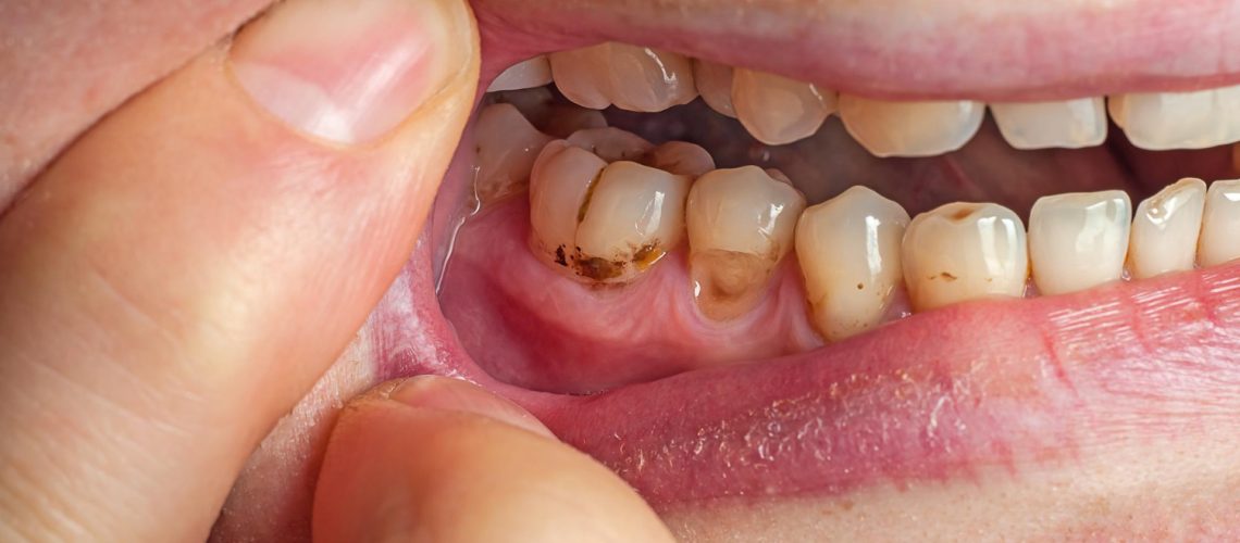 Understanding the Difference Between Cavities and Stains