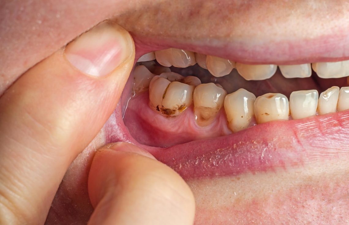 Understanding the Difference Between Cavities and Stains