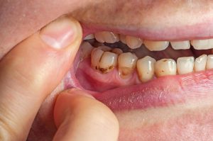 Understanding the Difference Between Cavities and Stains