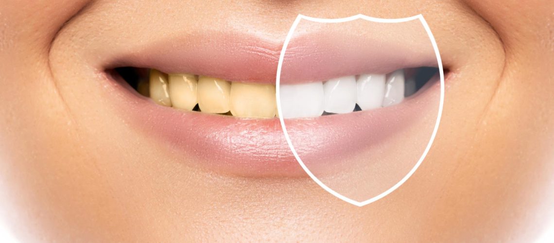 A Guide to Teeth Stain Removal in Dubai