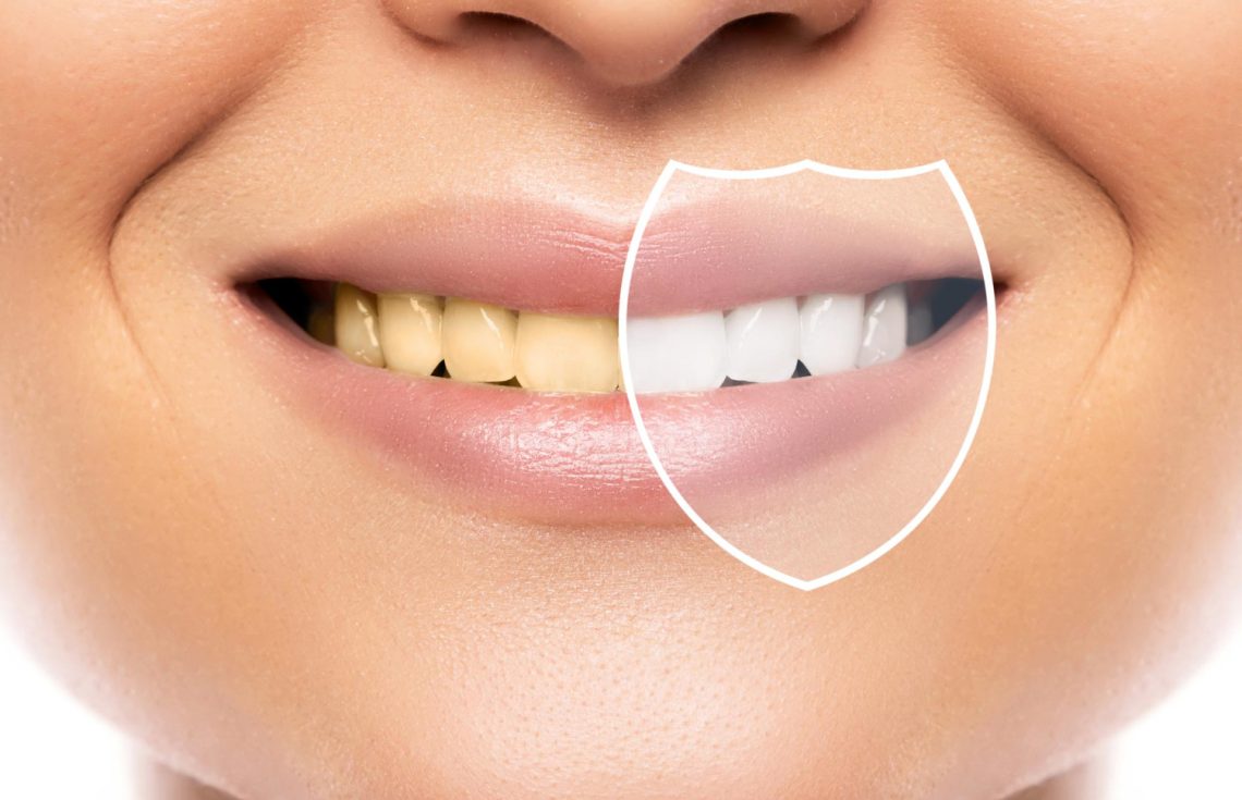 A Guide to Teeth Stain Removal in Dubai