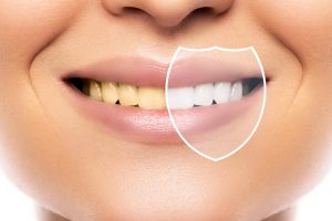 A Guide to Teeth Stain Removal in Dubai
