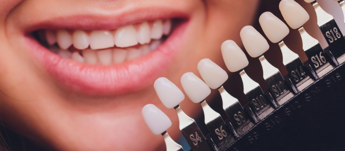 Dental Veneers Procedure A Step-by-Step Guide