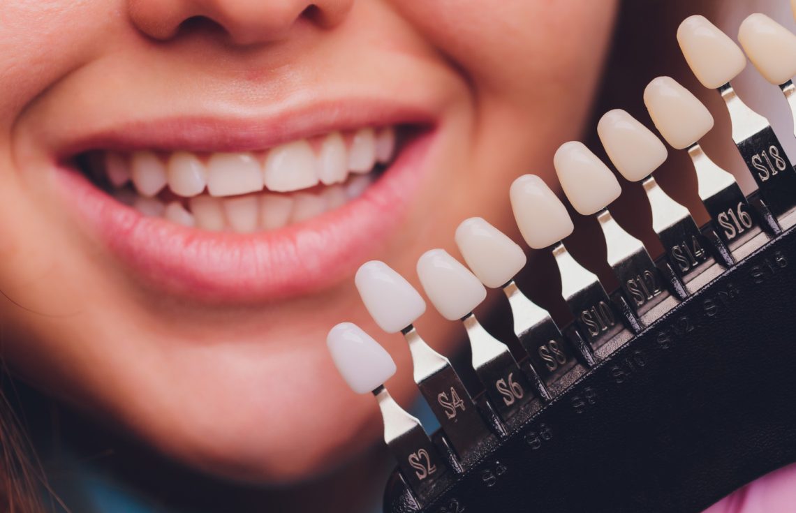 Dental Veneers Procedure A Step-by-Step Guide