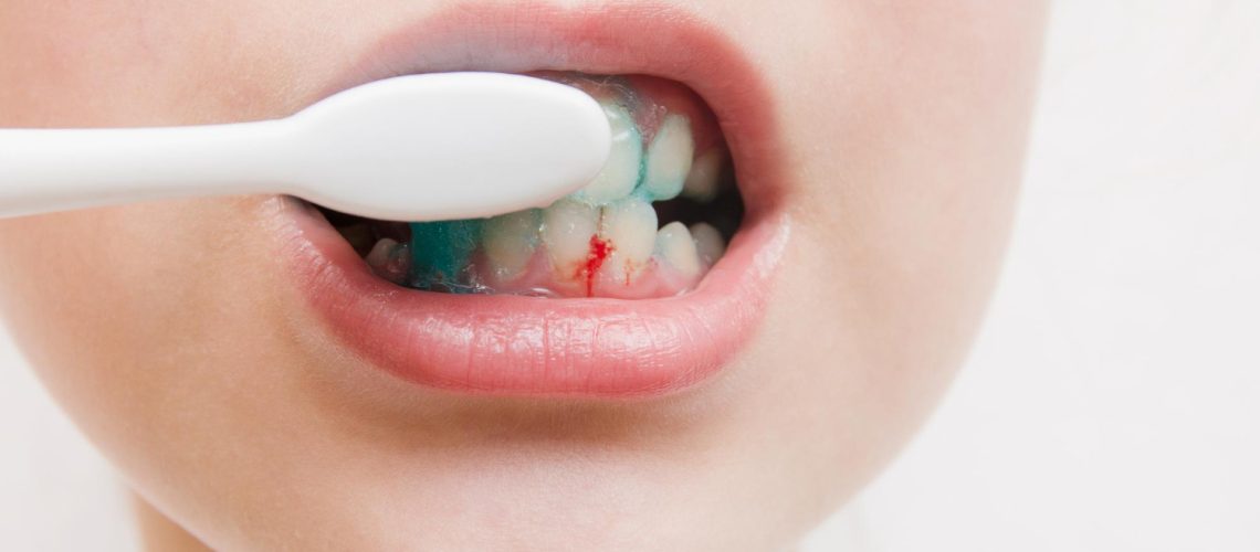 Gum Bleeding Symptoms, Causes and Treatment