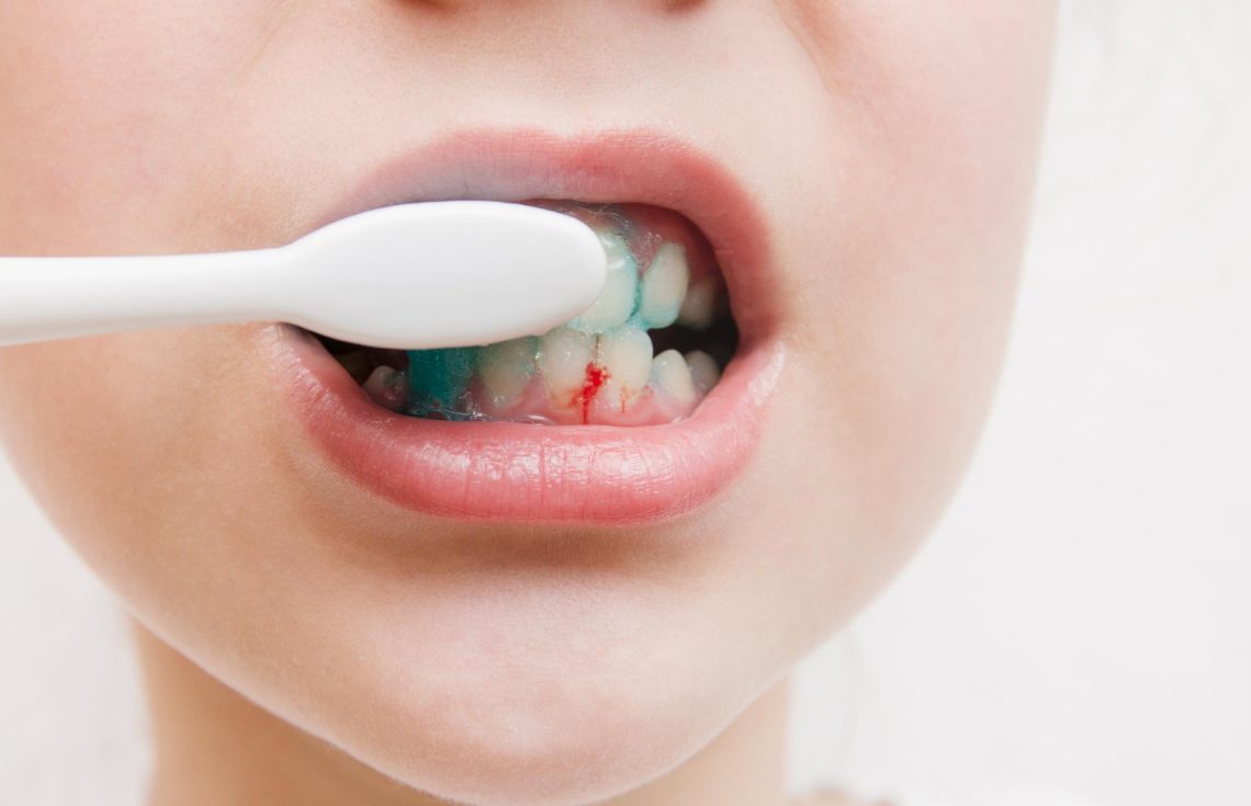 Gum Bleeding Symptoms, Causes and Treatment